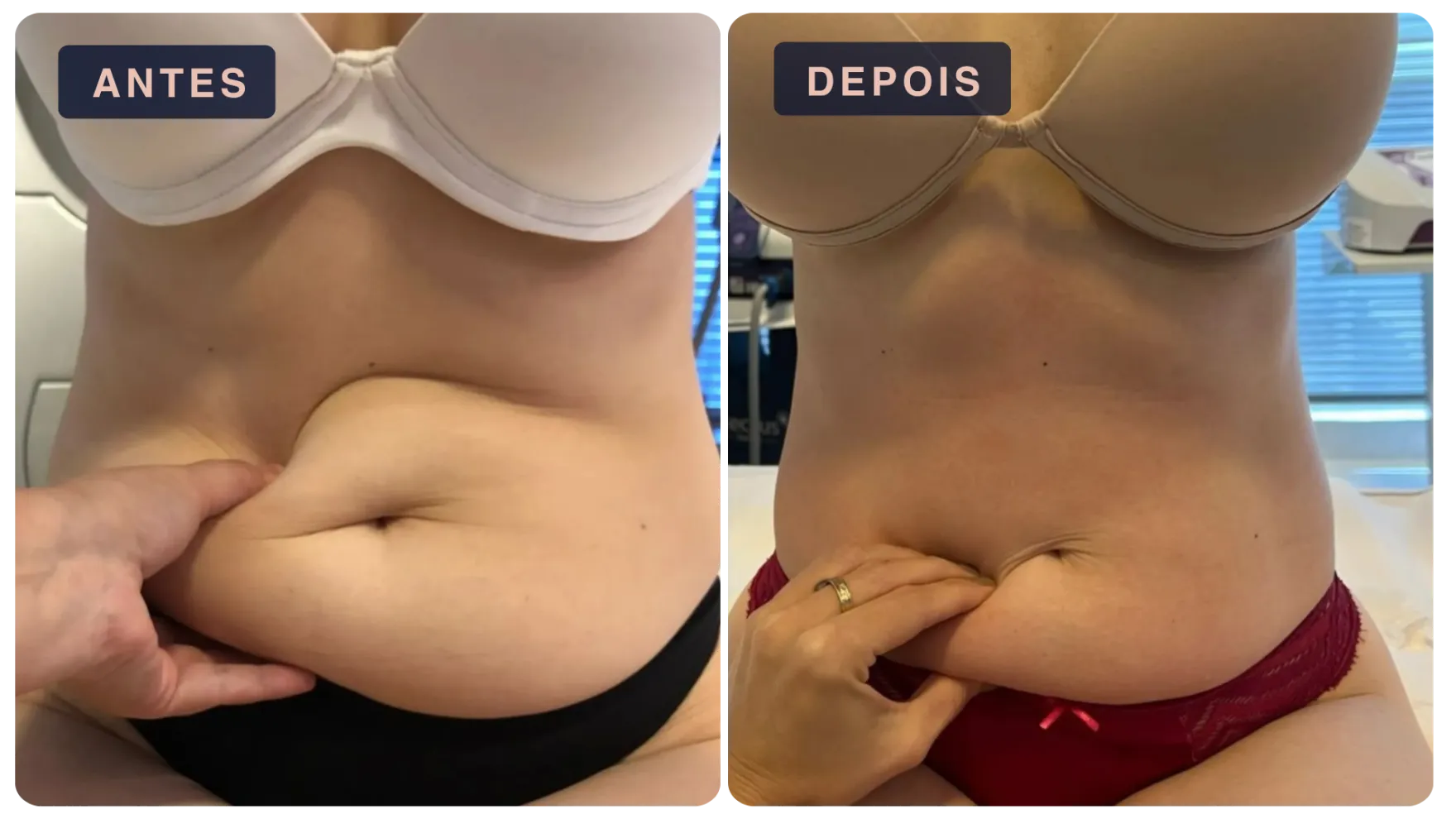 Paciente antes e depois do tratamento